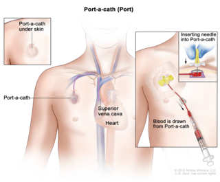 Port a Cath illustration