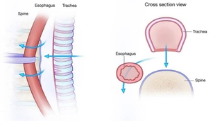 Posterior tracheopexy intra-op