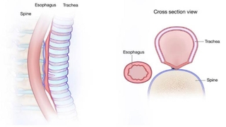 Posterior tracheopexy post-op