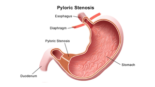 pyloric stenosis illustration