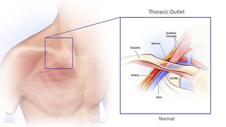 Thoracic outlet syndrome