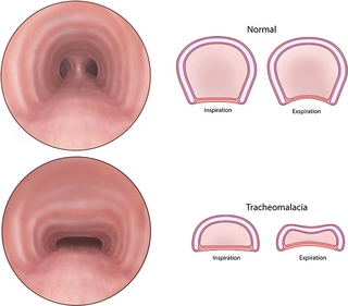 Tracheopexy