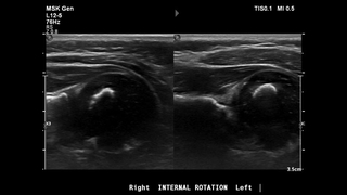 Ultrasound assessment of glenohumeral dysplasia