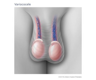 Varicocele Illustration