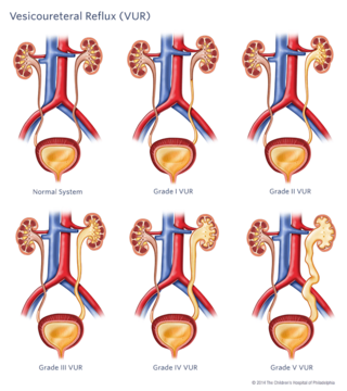 Vesicoureteral Reflux Illustration