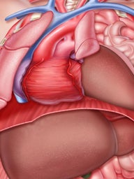 Congenital Diaphragmatic Hernia (CDH) Internal View of Abdomen