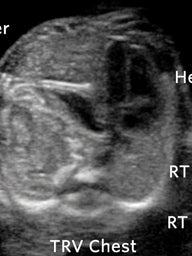 CDH Congenital Diaphragmatic Hernia Ultrasound