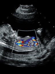 fetal echocardiogram