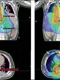 radiation treatment plans