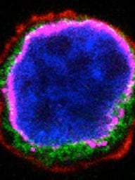 Photograph of an acute lymphoblastic leukemia cell