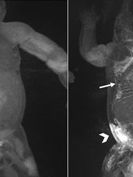 MRIs showing dynamic contrast MR lymphangiography (DCMRL) in neonatal chylothorax and CLFD