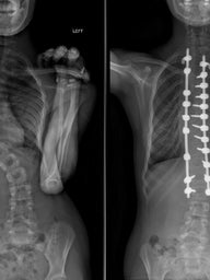 xrays showing idiopathic scoliosis