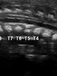 Fetal CT showing sagittal view of single anomalous vertebrae