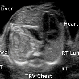 CDH Congenital Diaphragmatic Hernia Ultrasound