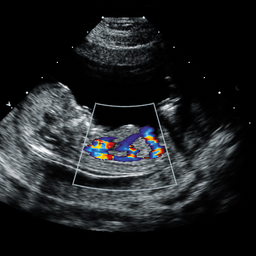 fetal echocardiogram