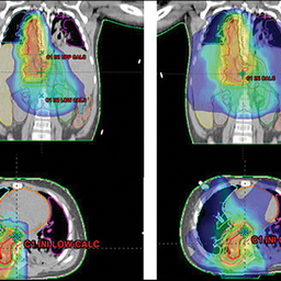 radiation treatment plans