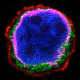 Photograph of an acute lymphoblastic leukemia cell