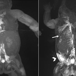 MRIs showing dynamic contrast MR lymphangiography (DCMRL) in neonatal chylothorax and CLFD