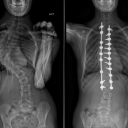 xrays showing idiopathic scoliosis