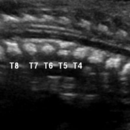 Fetal CT showing sagittal view of single anomalous vertebrae