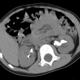 CT of patient 