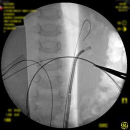 A fluoroscopy image from the surgery