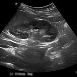 Renal bladder ultrasound