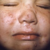 Child with chickenpox