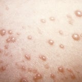 Chickenpox rash