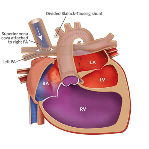 Single Ventricle Heart Defect and Chylothorax: Emmett’s Story ...