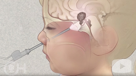 Pediatric Brain Tumor video screen