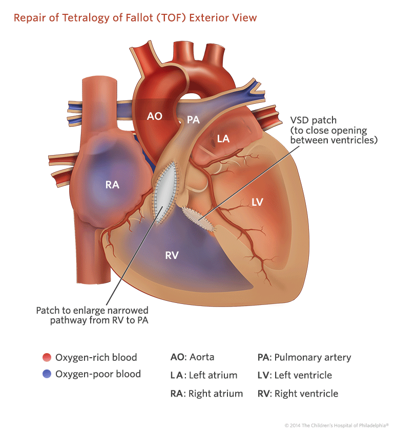 Tetralogy of Fallot (TOF) | Children's Hospital of Philadelphia