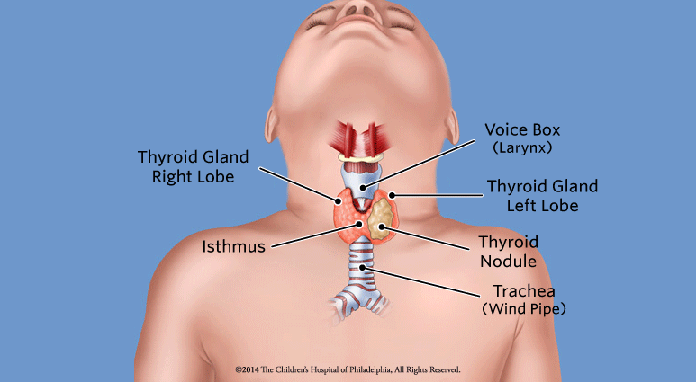 Thyroid Nodules Children s Hospital Of Philadelphia