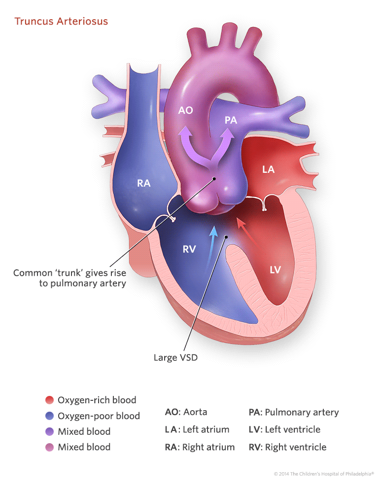 Truncus Arteriosus | Children's Hospital of Philadelphia